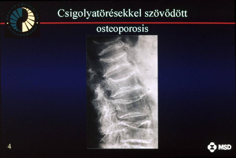 Csigolyatörésekkel szövődött oszteoporózis